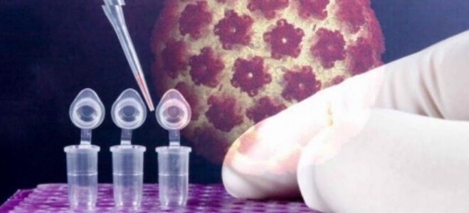 HPV diagnosztika a digene teszt segítségével